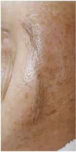 Testo Kur Vorher Nachher Bilder